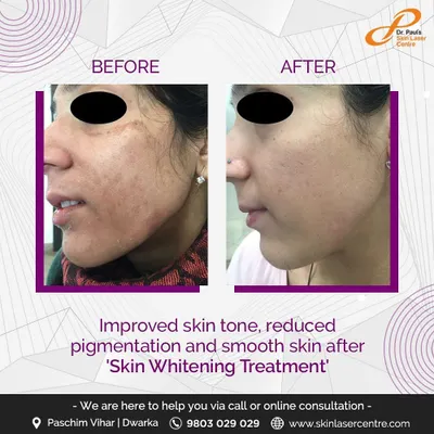 This patient achieved a more even skin tone and reduced pigmentation after a skin whitening treatment. This procedure, often a chemical peel, helps regenerate the skin for a smoother appearance.
