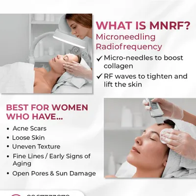 Microneedling Radiofrequency, or MNRF, is a powerful combination therapy. Micro-needles create tiny channels in the skin to boost collagen, while radiofrequency waves deliver heat to tighten and lift. It's highly effective for acne scars, loose skin, and uneven texture.