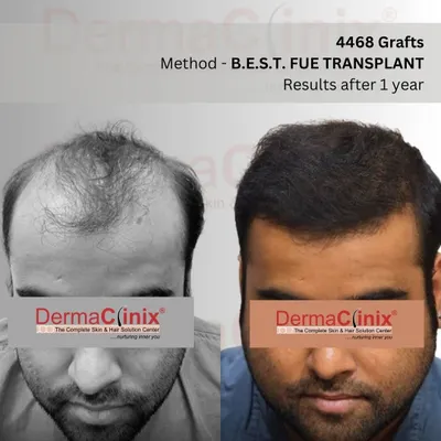 A one year transformation using our B.E.S.T. FUE method with 4468 grafts. We focus on creating a perfectly natural looking hairline that blends seamlessly, showcasing the blend of our artistic and surgical skills.