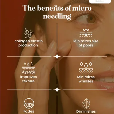 Microneedling is a sophisticated procedure that stimulates your skin's natural reparative processes. It is highly effective for improving texture, minimizing pores, fading pigmentation, and diminishing acne scarring by boosting collagen and elastin production.