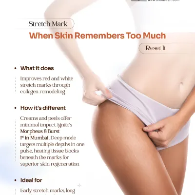 Stretch marks occur when the skin's structure is compromised, and topical creams often provide minimal improvement. I use Morpheus8 Burst, a deep-mode radiofrequency technology, to remodel collagen and improve the texture of both red and white stretch marks by targeting multiple skin depths in a single pulse.