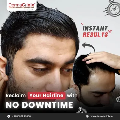 This graphic illustrates the immediate transformation possible with my Long Hair FUE method. You can reclaim your hairline with no downtime, making it a perfect choice for busy professionals and those seeking a discreet procedure.