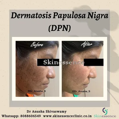 This before-and-after shows the successful treatment of Dermatosis Papulosa Nigra (DPN), which are small, dark growths common on the face and neck. Using a CO2 laser, I can clear these lesions effectively, resulting in much smoother and clearer skin.