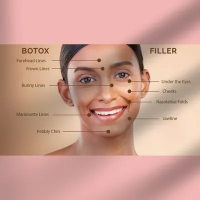 This facial map clearly distinguishes between the areas I treat with Botox versus Fillers. Botox addresses dynamic wrinkles caused by muscle movement, while fillers restore volume and treat static lines.