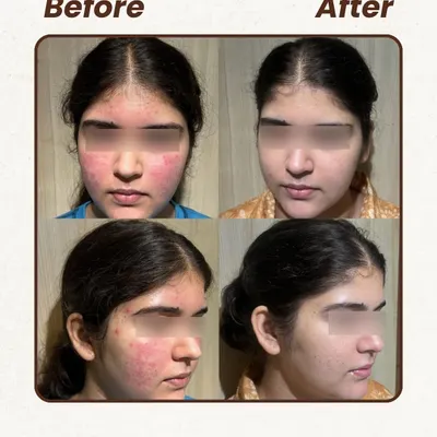 This is a powerful example of treating severe inflammatory acne. We focused on reducing the inflammation first, then clearing the active breakouts, and finally addressing the redness and texture. It's a step-by-step process that delivers lasting results.