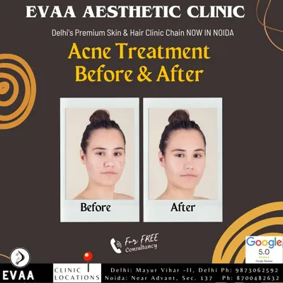A before-and-after comparison demonstrating the effectiveness of our acne treatment protocols in clearing breakouts and improving skin clarity.