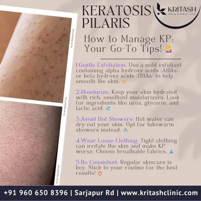 Keratosis Pilaris, or KP, presents as small, rough bumps on the skin. Management involves a consistent routine of gentle chemical exfoliation with ingredients like lactic or glycolic acid, followed by a rich moisturizer containing urea or glycerin to soften the keratin plugs.