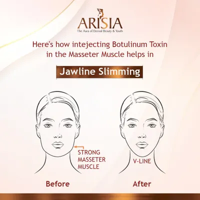 This illustration shows how injecting Botulinum Toxin into the masseter muscle achieves jawline slimming. By relaxing this strong muscle, we can transition the face from a square shape to a more defined V-line.