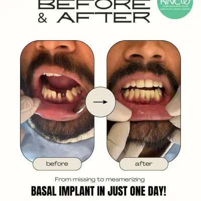 This before and after image shows the immediate, life-changing results of my Basal Implant technique. We took this patient from having missing and damaged teeth to a full, functional, and confident smile in just one day, without the need for complex bone grafting.