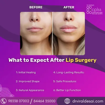 This before-and-after image demonstrates the subtle yet significant impact of lip surgery. My focus is on creating a natural-looking enhancement that restores volume and improves shape, ensuring the results are in perfect harmony with your overall facial features.