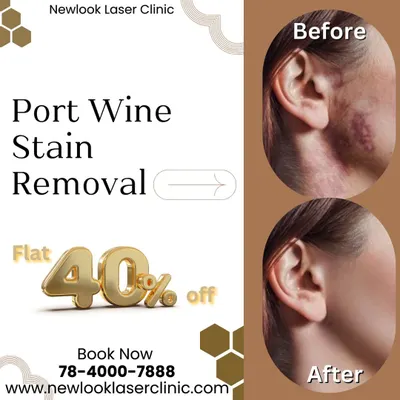 We are currently offering a special 40 percent discount on our advanced Port Wine Stain removal treatments. This promotion is a great opportunity to begin your journey toward clearer skin with our expert team.
