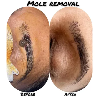 A clear before and after of a mole removal on the eyebrow. This scarless procedure was performed to remove a growth that was a cosmetic concern for the patient, resulting in a clean and natural look.