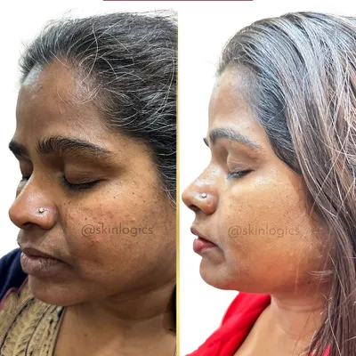 A clear example of our skin lightening treatment. The 'before' image shows dullness and uneven pigmentation, while the 'after' image displays a visibly brighter, more luminous, and even-toned skin, achieved through a personalized treatment protocol.