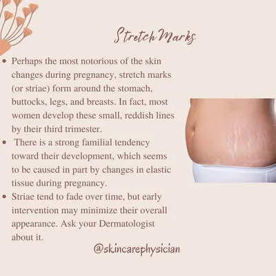 Stretch marks, or striae, are one of the most notorious skin changes during pregnancy. They are caused by changes in elastic tissue, and while early intervention can help, genetics play a strong role.