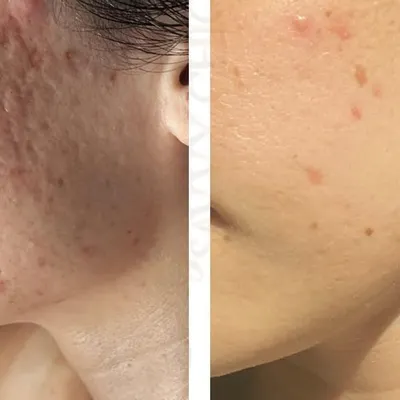 This before-and-after demonstrates a significant reduction in deep, textured acne scars. My treatment plan combined multiple modalities to rebuild collagen and smooth the skin's surface, restoring both texture and confidence.