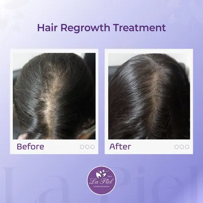 This before-and-after image shows a significant improvement in hair density for a patient concerned with a widening parting line. My focus is on creating personalized treatment plans that address the root cause of hair thinning to achieve visible, confidence-boosting results like this.