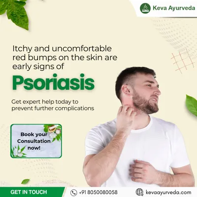 Itchy and uncomfortable red bumps can be early signs of Psoriasis. We provide expert Ayurvedic help to manage the condition and prevent further complications.