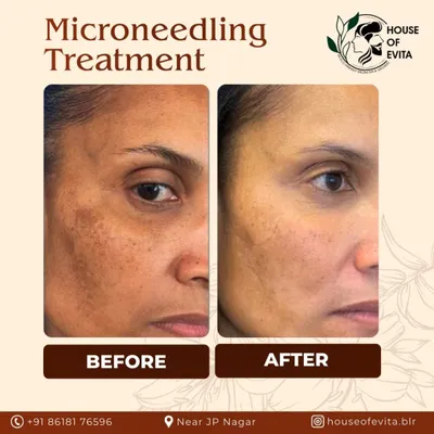 This before-and-after image shows the significant reduction in hyperpigmentation and sun spots after a series of microneedling sessions. We use this procedure to stimulate your skin's natural collagen production, effectively treating acne scars, fine lines, and uneven skin texture for a smoother, clearer complexion.