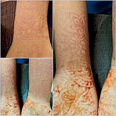 This is a case of irritant contact dermatitis caused by an allergic reaction to mehendi. It's a reminder to always do a patch test before applying products to your skin and to see a dermatologist immediately if you notice any irritation.
