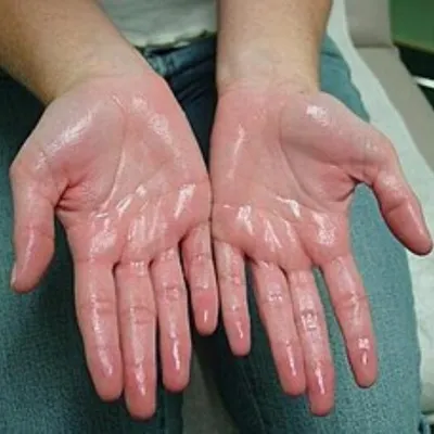Palmar hyperhidrosis, or excessive sweating of the hands, can be socially and professionally challenging. I offer effective treatments like Botox injections that can significantly reduce sweating and improve your quality of life.