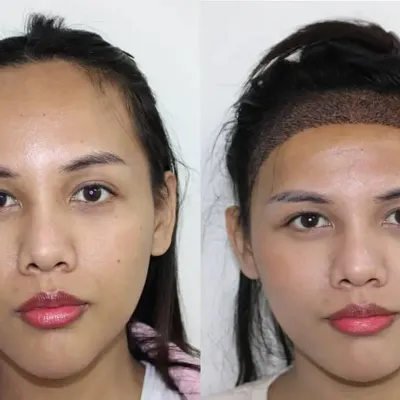This patient wanted to lower her hairline to achieve better facial harmony. The 'before' shows her naturally high hairline, and the 'after' shows the immediate result post-procedure, with the new hairline clearly defined.