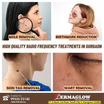 This collage showcases the range of conditions we treat with radio frequency. We provide high-quality solutions for mole removal, birthmark reduction, skin tag removal, and wart removal to help you achieve clear, smooth skin.
