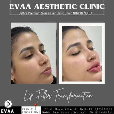 A stunning lip filler transformation. This before-and-after comparison shows how we can significantly enhance lip volume and shape, creating a fuller, more defined pout while maintaining a natural look.