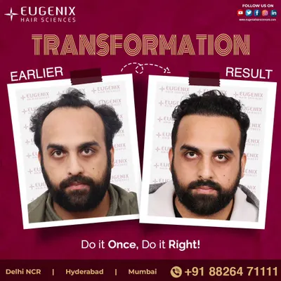 A clear comparison showing the powerful change a well-executed hair transplant can make. We focus on creating a result that is not only dense but also perfectly frames the face for a natural and revitalized appearance.