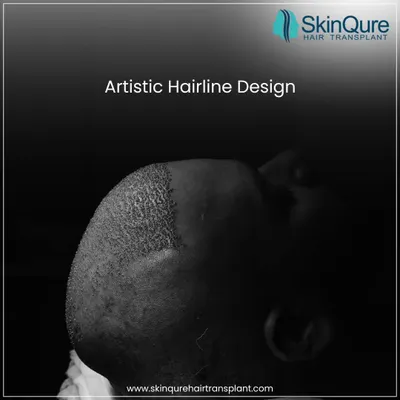 The hairline is the signature of a hair transplant. This image shows the immediate post-operative result of an artistic hairline design. The goal is to create a soft, irregular line that mimics nature, not a harsh, straight one.