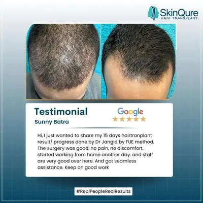 Sunny Batra shares his 15-day progress after an FUE procedure. He highlights that the surgery was good, with no pain or discomfort, and that he received seamless assistance from my team. It's great to see patients feeling comfortable and well-cared for.