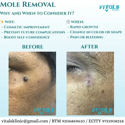 A clear before-and-after of a facial mole removal. The procedure was performed to enhance cosmetic appearance and boost the patient's confidence, leaving behind smooth, clear skin with minimal marking.