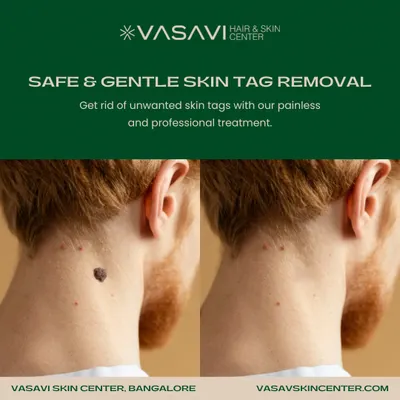 This is a typical result of a skin tag removal from the neck. The procedure is straightforward and provides an immediate cosmetic improvement, leaving the skin clear and smooth.