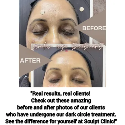 A real client's before-and-after results from our dark circle treatment. This image clearly shows the significant reduction in pigmentation and hollowness, resulting in brighter and more refreshed-looking eyes.