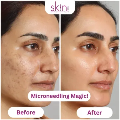 A powerful before-and-after comparison showcasing the transformative results of microneedling. This demonstrates my ability to significantly reduce acne scarring and improve overall skin texture for a smoother, clearer complexion.