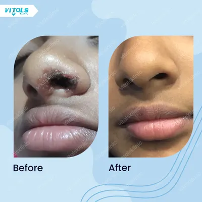 This before-and-after shows the successful removal of a pigmented lesion on the nose. Using precise techniques, we can safely remove unwanted spots and restore the skin's clear, even appearance.