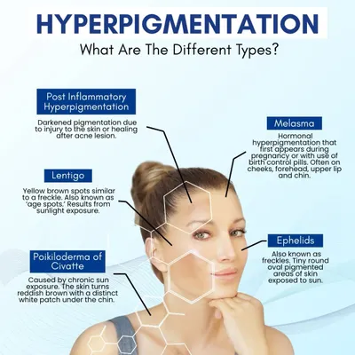 Hyperpigmentation is not a single condition. This educational graphic explains the different types, from post-inflammatory marks after acne to melasma and sun-induced lentigo. Each type requires a specific treatment approach for effective results.