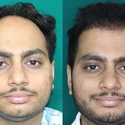 This front-on view shows the dramatic impact of a restored hairline. The patient's face is now framed naturally, giving him a much younger and refreshed look. This is the power of a well-designed hair transplant.