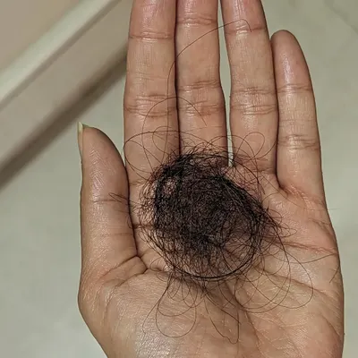 We often hear that losing 100 hairs a day is normal, but what does that actually look like? This image shows a ball of 100 medium-length hairs to help you gauge if your hair fall is within the normal range.