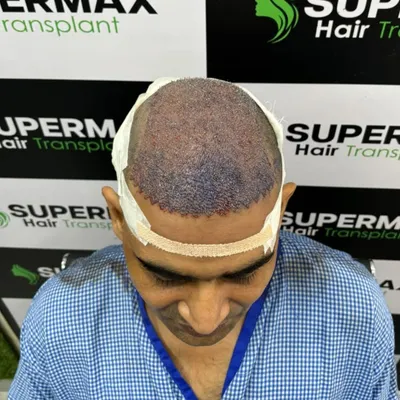 This is what the scalp looks like immediately after the DHI procedure. The grafts are densely packed to ensure a full look.