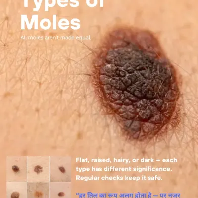 Moles come in many forms: flat, raised, hairy, or dark. Regular checks are important to ensure they remain safe. I provide mole mapping services to track any changes over time.