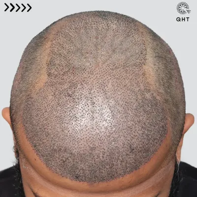 A look at the scalp just after surgery for a Grade 6 case. 5700 grafts were meticulously placed in a single session to recreate the hairline and add density from the frontal area to the crown.