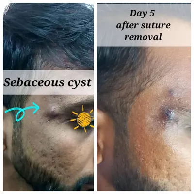 This before-and-after comparison demonstrates the result of a sebaceous cyst excision. The image on the right shows the area just five days after I removed the cyst and the sutures, highlighting the clean healing process with my technique.