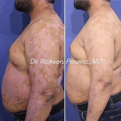 This side view shows the dramatic clearance of psoriasis plaques after just two weeks of biologic therapy. This treatment targets the specific inflammatory cause of the disease, allowing patients to regain confidence and participate in activities they once avoided.