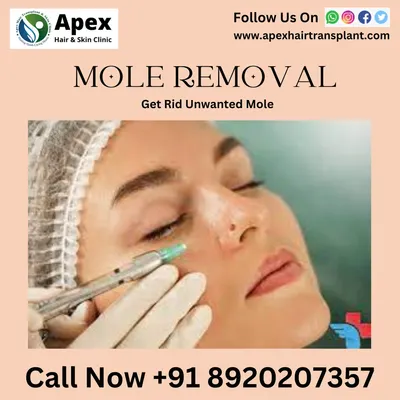 If you have an unwanted mole, we offer a safe and virtually painless removal procedure. Our dermatologists use precise techniques to remove moles with minimal discomfort and scarring, helping you achieve the clear skin you desire.