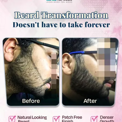 A clear example of a successful beard restoration. The before photo shows significant patchiness on the cheek, while the after photo highlights a dense, patch free finish that looks completely natural.