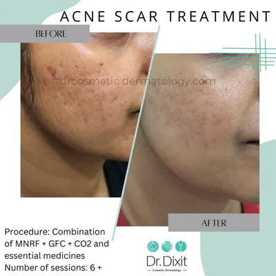 A combination of MNRF, GFC, and CO2 laser helped significantly reduce the depth and texture of these acne scars. This multi-modal approach ensures we address the scars at different levels of the skin.
