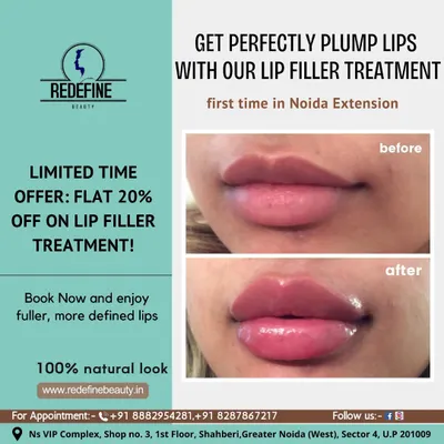 A clear before-and-after of my lip filler treatment. Notice the improved volume and definition in the 'after' photo, creating a beautifully plump and natural-looking result. This enhancement was done to meet the client's specific goals for fuller lips.