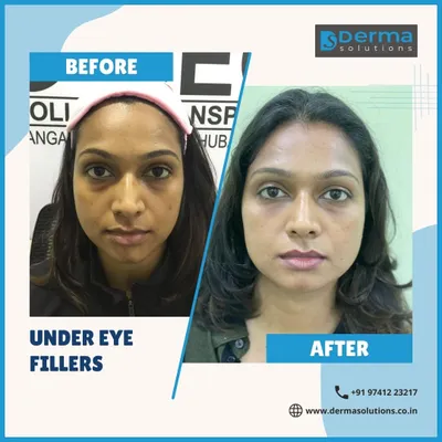 This before and after result is a powerful demonstration of under-eye filler treatment. Notice how filling the tear trough hollows completely transforms the patient's expression from tired to vibrant and refreshed.