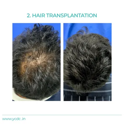 A clear comparison showing significant improvement in hair density on the crown area after a hair transplant procedure. My goal is to fill in thinning areas for a fuller look.
