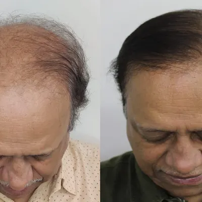 This patient presented with Grade 7 baldness at 64 years of age. This top-down view shows the incredible coverage we achieved, proving that even the most advanced cases can be treated successfully.